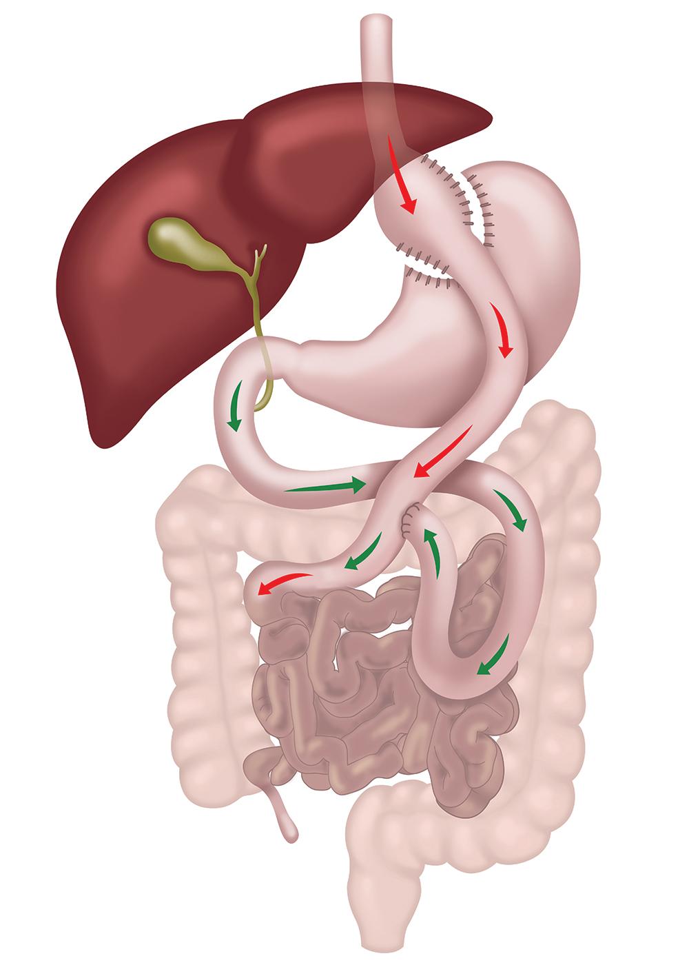 Gastric Bypass (Roux-en-Y)