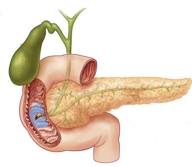 Gallbladder Surgery