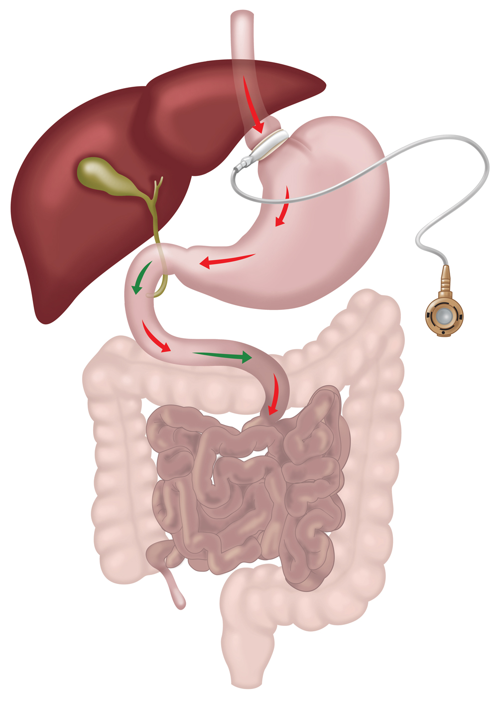 Laparoscopic gastric band surgery diagram