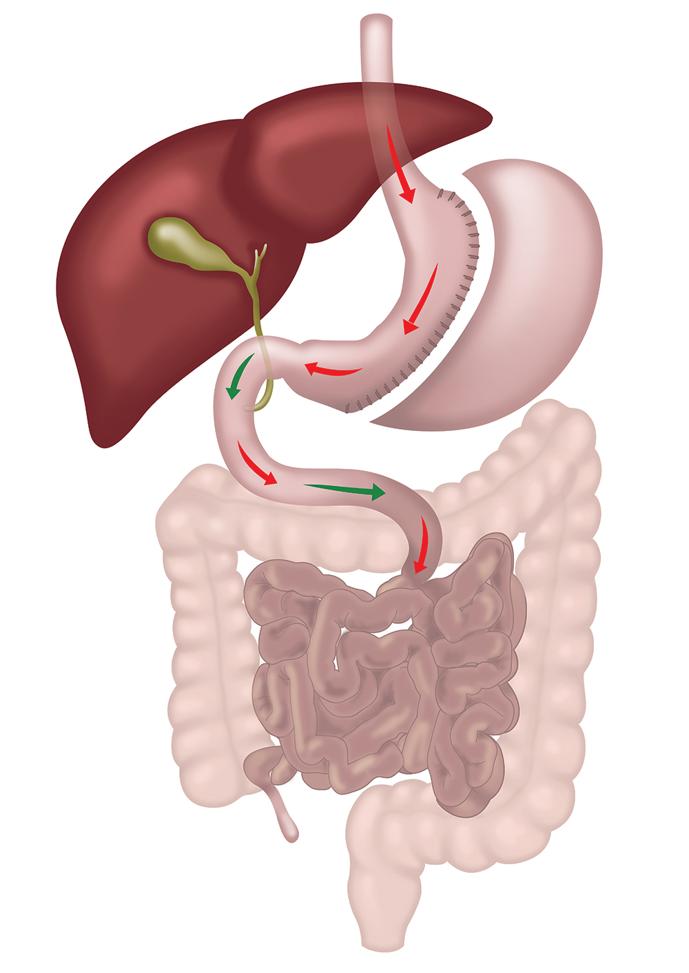 Laparoscopic Sleeve Gastrectomy diagram showing reduced stomach size