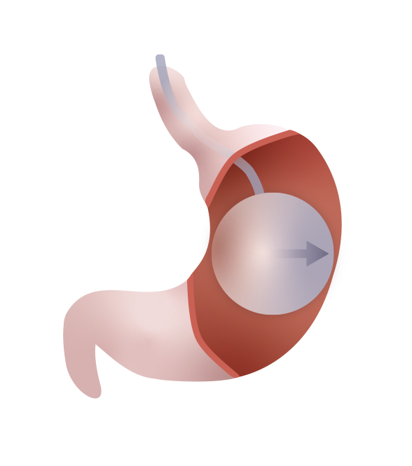 Intragastric balloon placed in stomach