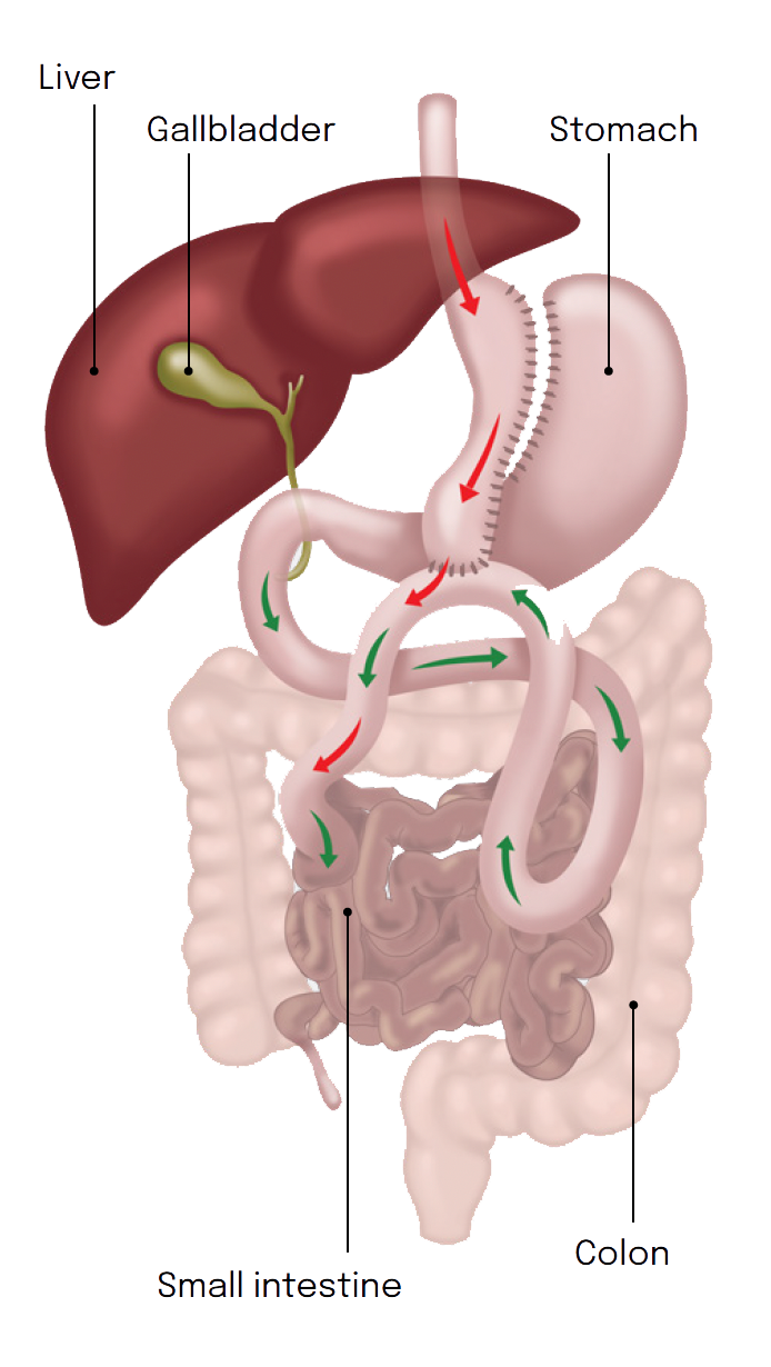 One Anastomosis Gastric Bypass OAGB diagram showing stomach pouch and intestinal connection