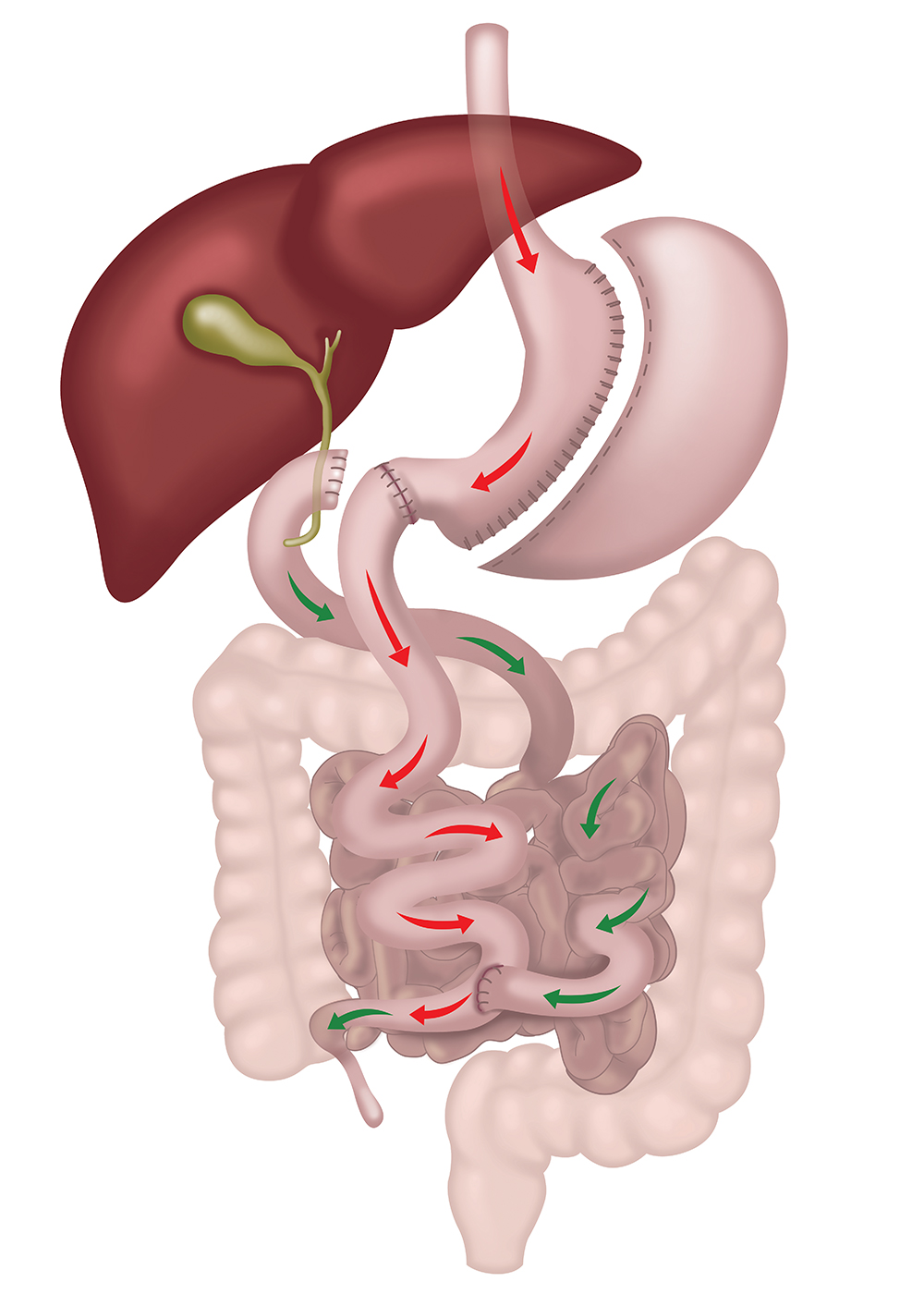 SADI single anastomosis duodeno-ileal bypass with sleeve gastrectomy diagram