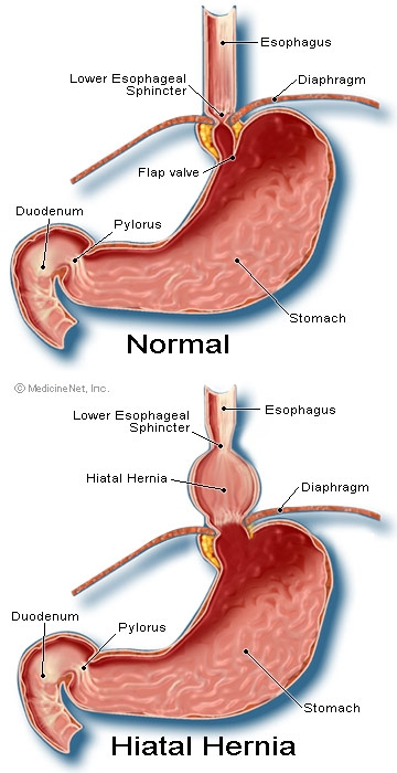 Hiatus hernia diagram