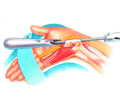 Carpal tunnel release