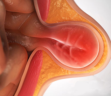 Hernia repair surgery